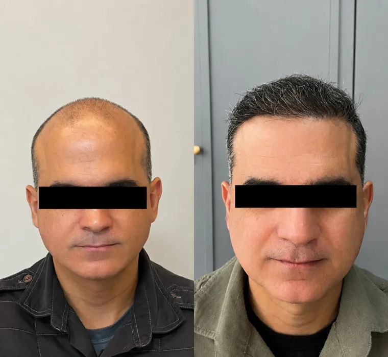 Paciente antes e depois do transplante capilar FUE, vista frontal