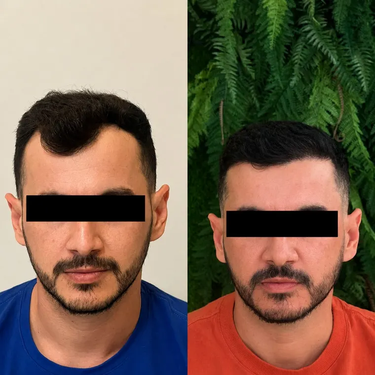 Paciente antes e depois do transplante capilar FUE, entradas preenchidas