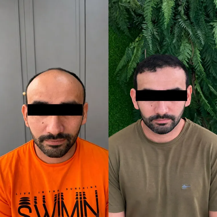 Paciente antes e depois do transplante capilar FUE, calvície frontal