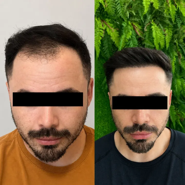 Paciente antes e depois do transplante capilar FUE, linha frontal
