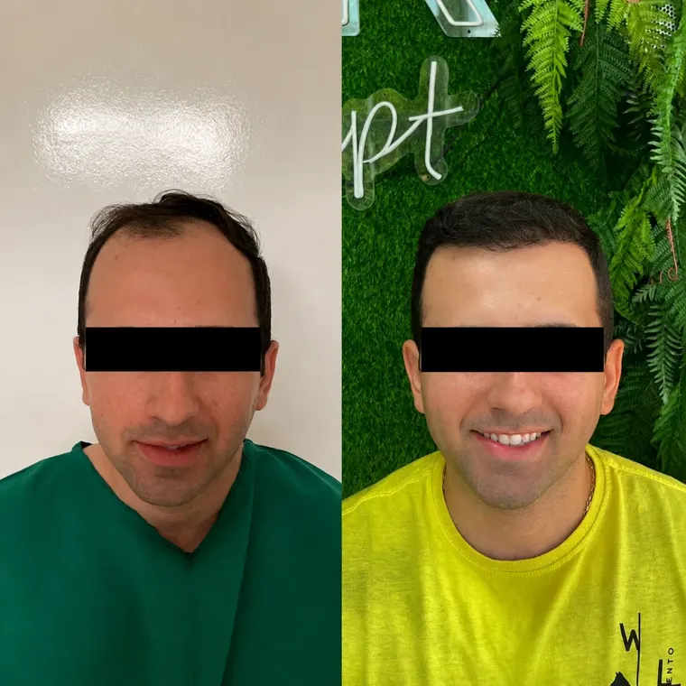 Paciente antes e depois do transplante capilar FUE, entradas