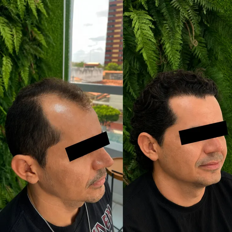 Paciente antes e depois do transplante capilar FUE, vista lateral