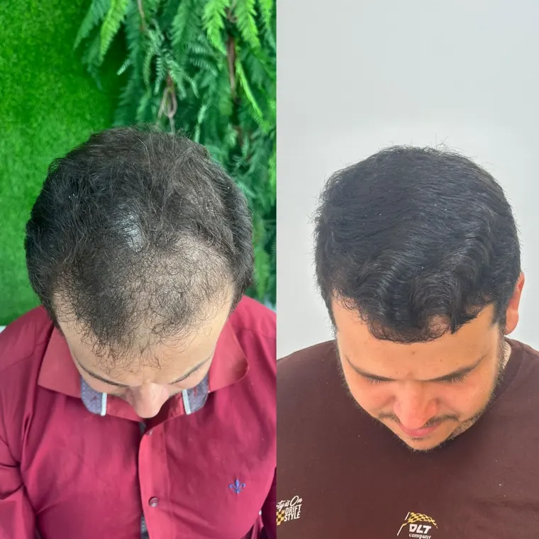 Paciente antes e depois do transplante capilar FUE, vista de cima