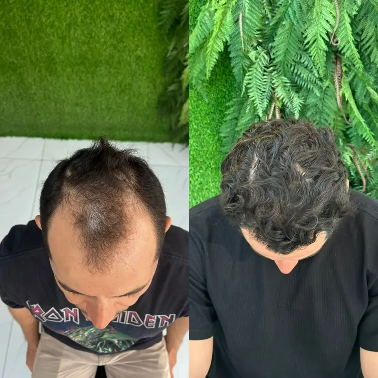 Paciente antes e depois do transplante capilar FUE, coroa preenchida